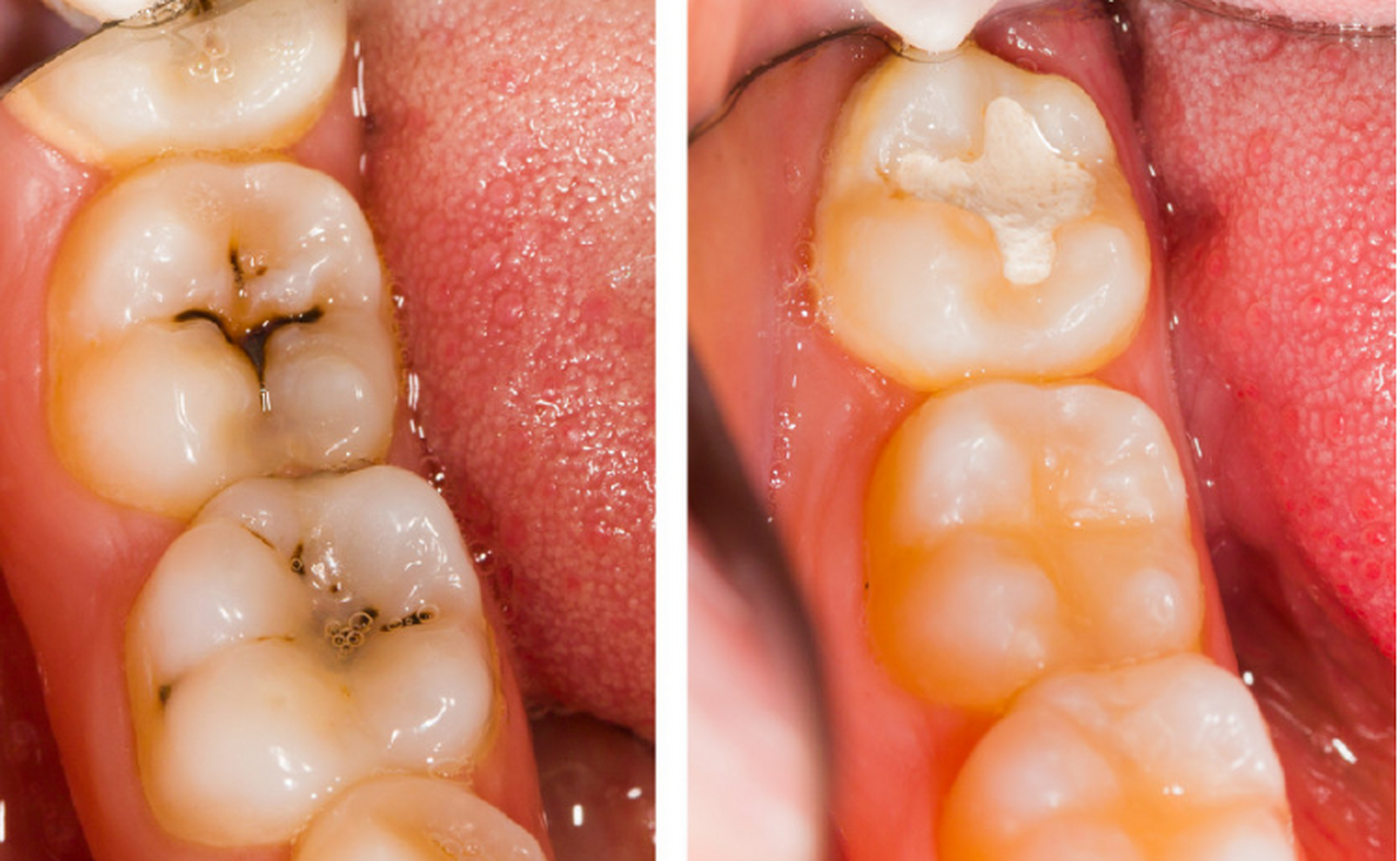 为什么会梦到牙坏掉了(为什么会梦到牙坏掉了呢)